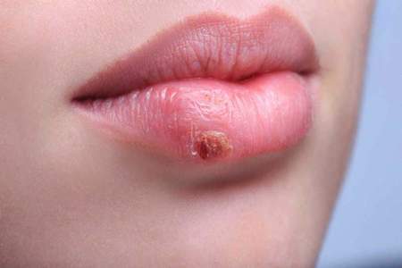 Left or right herpes labial
