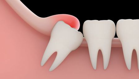 Left or right dente do siso 0817 1400x8001